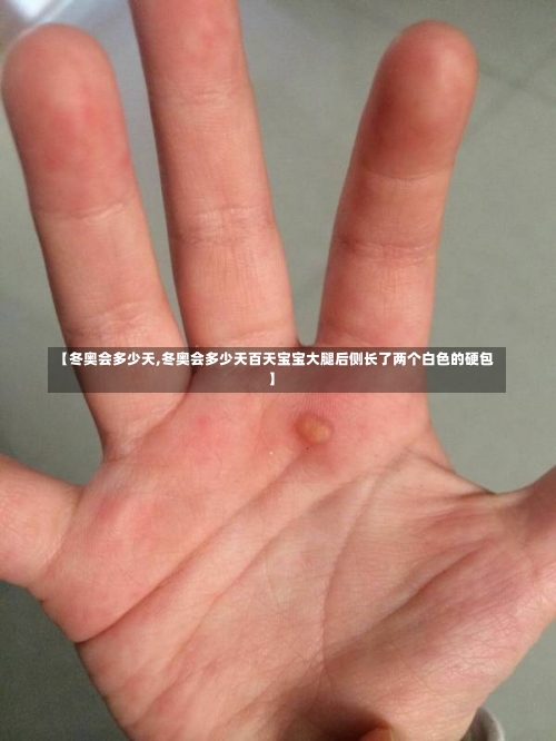【冬奥会多少天,冬奥会多少天百天宝宝大腿后侧长了两个白色的硬包】-第1张图片